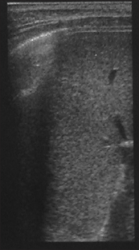 Normal splenic echotexture seen on follow-up USG