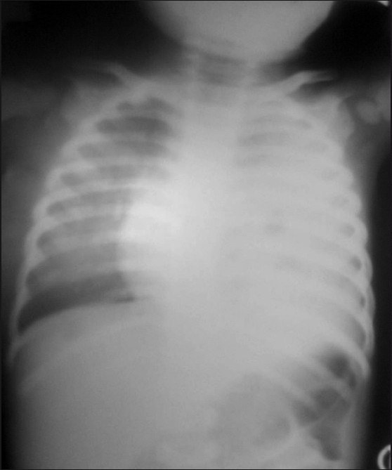 X ray chest showing left sided pleural effusion.