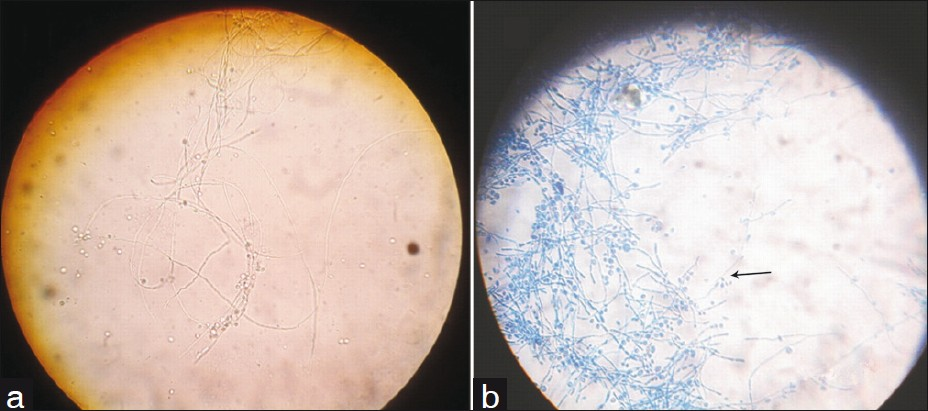 (a) KOH preparation of sputum shows fungal elements. (b) LCB mount of sputum culture shows septate hyphae with many pear-shaped to almost round conidia and forming rosette (arrow) on delicate sterigmata at 25°C.