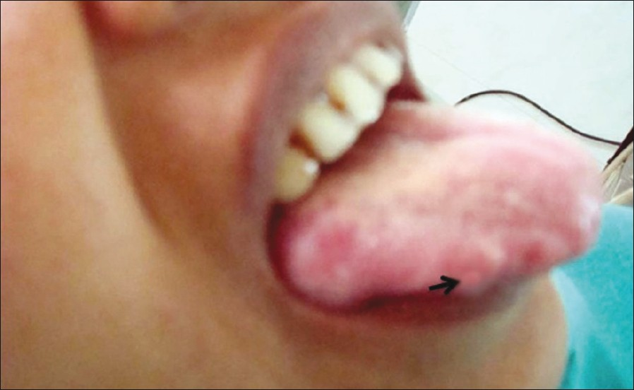 Swelling right lateral border of tongue (arrow)