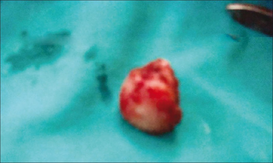 Excised cyst