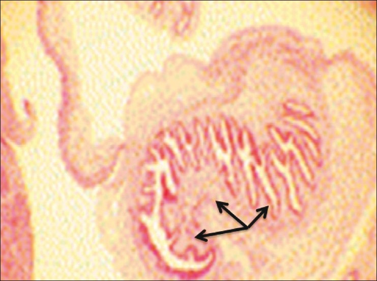 Cystic cavity containing cysticercus cellulosae larvae (H and E, 10×)