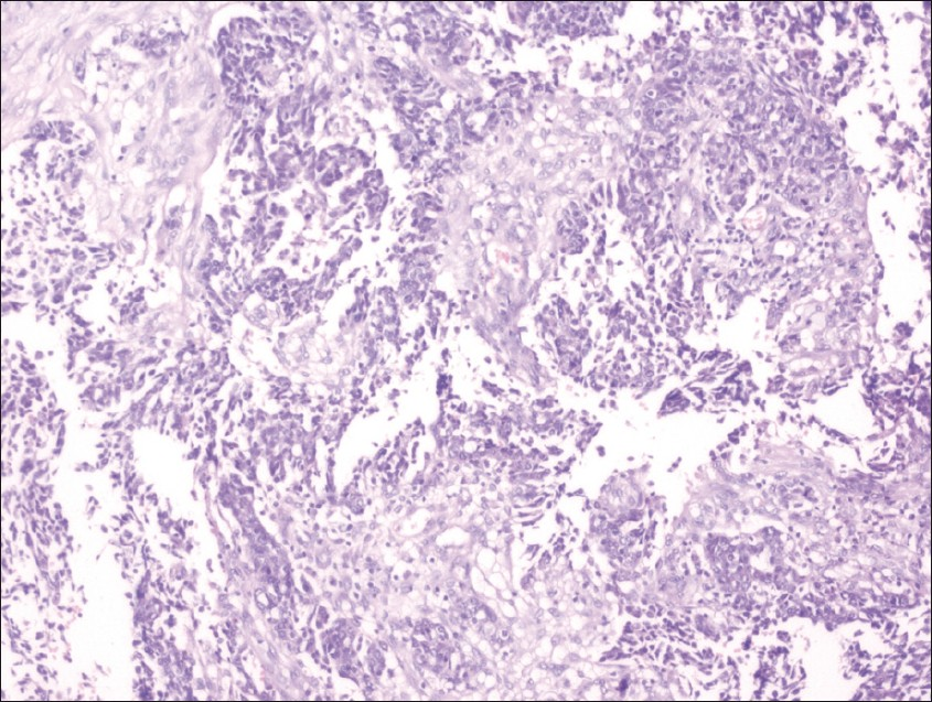 Microsection shows predominantly papillary pattern of adenocarcinoma with glandular formation at places (H and E, ×100).