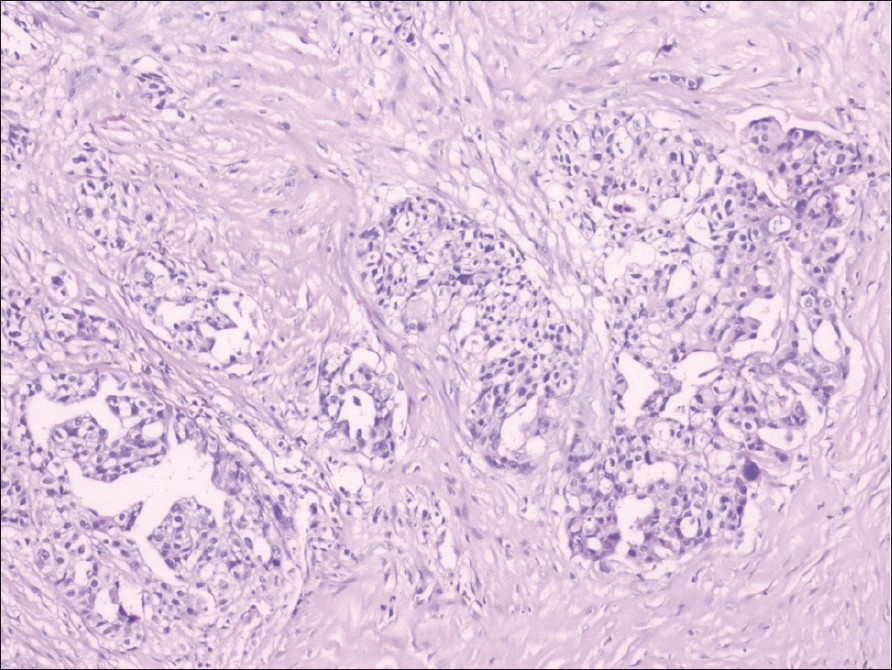 Microsection shows nests of adenocarcinoma in an otherwise unremarkable ovarian stroma (H and E, ×100).