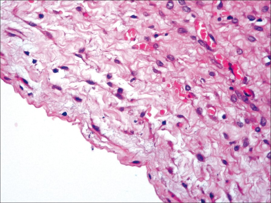 Ovarian cyst wall composed of ovarian stroma and congested blood vessels, no lining epithelium seen. (H and E, ×400)