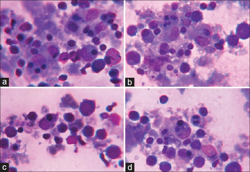 (a-d) Phagocytosis of erythroid precursors in bone marrow smears (Leishman stain, oil immersion ×1000)