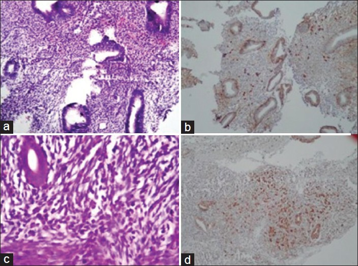 (a) Irregular endometrial glands showing mild stromal breakdown. H and E, ×100; (b) IHC showing plasma cells concentrated beneath endometrial glands. ×100. (c). Plasma cells clearly seen on H and E, ×100; (d) Grade 3 plasma cells on IHC which are concentrated beneath glands ×100