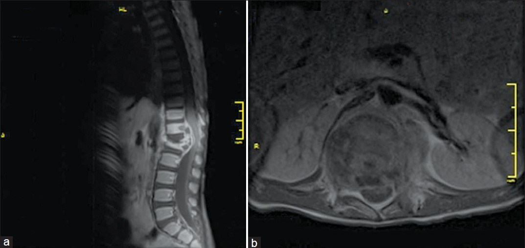 Magnetic resonance imaging of the lumbar spine in sagital and axial slices after injection of Godolinium (a) destructive mass at the level of L1 vertebra with soft tissue infiltration (b) L1 spondylitis causing kyphosis and compression of the cauda equina