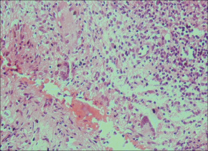 Histopathologic examination showing granulomatous inflamation with caseous material