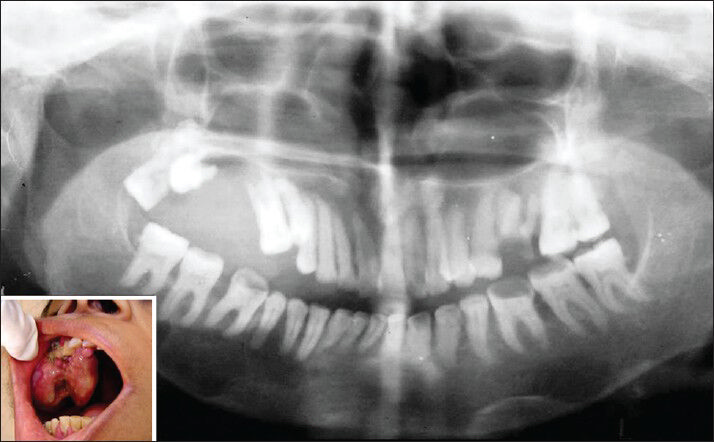 Intraoral photograph revealing a growth extending buccally and palataly i.r.t 12-18 region (inset) and orthopantomograph showing resorption of right maxillary alveolar region with multiple cyst-like radiolucent areas in right side of body of the mandible