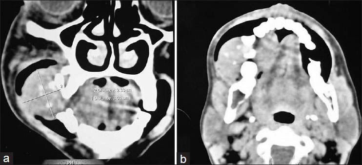 Computed tomography scan showing: (a) destruction of the alveolar bone in right maxilla and lytic lesion involving the left body of mandible and; (b) lytic lesion involving the left body of mandible