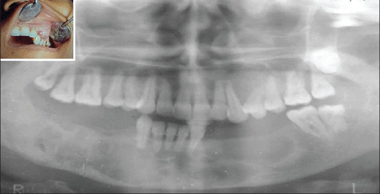 Intraoral photograph showing swelling on left side of maxilla (inset) and orthopantomograph showing resorption of left posterior maxillary alveolar region with multiple, radiolucent, cyst-like lesions involving whole of the body of mandible