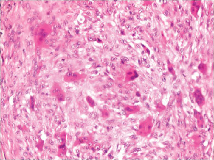 Photomicrograph (×40) showing multinucleated giant cells in fibrocellular stroma