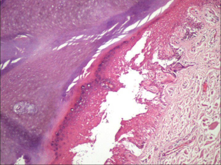 Hematoxylin andeosin-stained section (×10) showing intraepidermal separation