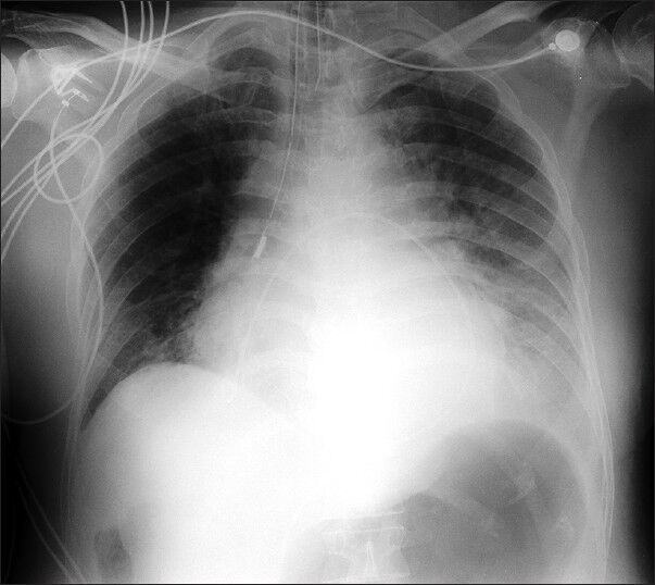Chest X-ray after pericardiocentesis showing a pig-tail catheter left in situ for continuous drainage