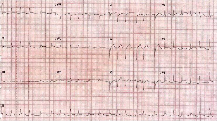 Electrocardiogram on admission showing low voltage waves in leads II, III and aVF; ST elevation in leads I, II, aVL and chest leads V1 – V6; atrial fibrillation and a fast ventricular rate of 134 beats/min