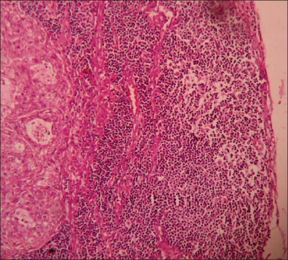 Microphotograph of peripancreatic lymphnode showing tumor metastasis (×400)