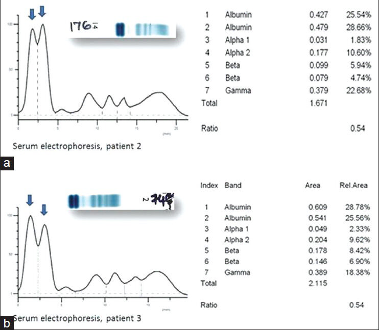 Densitometer tracing showing two peaks in the albumin region on serum electrophoresis from (a) patient 2 and (b) patient 3. Inset showing gel electrophoresis picture