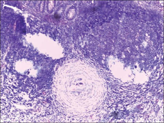 Section showing schistosoma ova within a granuloma and surrounded by chronic inflammatory cells’ infiltrate (H and E, ×200)