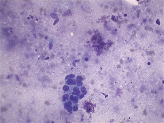 Benign follicular cells and background of caseating necrosis (Giemsa stain, ×400)