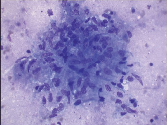 Epithelioid cell granuloma with caseating necrotic background (Giemsa stain, ×400)