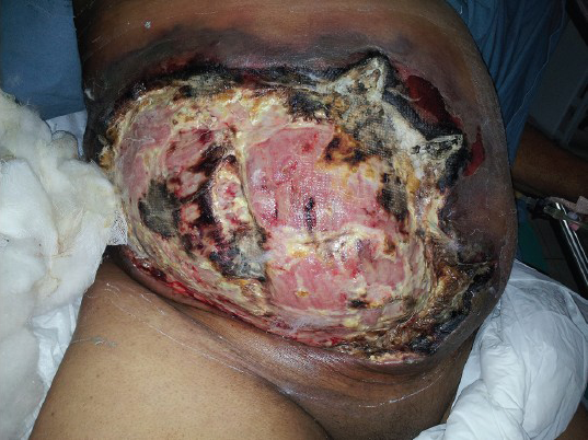 Extensive anterior abdominal wall necrosis, blackened edge of the lesion