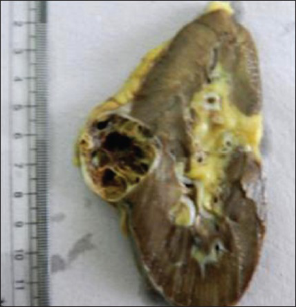 Left nephrectomy specimen showing an encapsulated growth with multiloculated, cystic growth. The cysts are filled with gelatinous material and are separated by thin septae