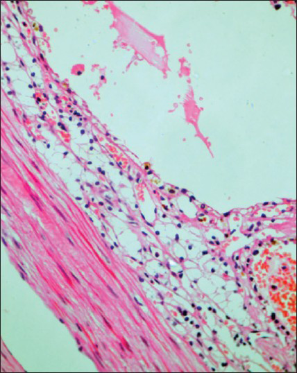 Cyst wall lined by clear cells with uniform hyperchromatic nuclei, inconspicuous nucleoli, clear cytoplasm and well–defined cell borders (H and E, ×40)