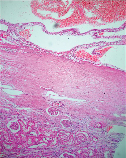 Cysts filled with hemorrhagic material with adjacent renal parenchyma showing degenerative changes–hyalinized glomeruli, interstitial fibrosis, and chronic inflammatory cell infiltrate. (H and E, ×40)