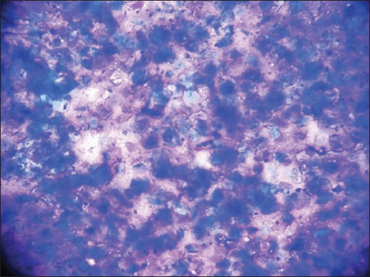 Fine-needle aspiration cytology showing many anucleated squames and few benign nucleated squamous cells in a dirty background (May-Grünwald-Giemsa, ×100)