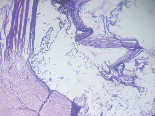 Histopathological section showing a cyst lined by keratinized squamous epithelium, cavity filled with lamellated keratin. No skin appendages seen (H and E, ×100)