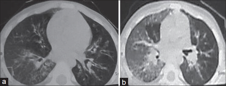 Chest high-resolution computed tomography. (a) Areas of ground-glass haze and nodular air space lesions in a branching pattern (tree in bud) in the right lower lobe, dilated and thickened bronchi in the left lower lobe, lingular lobe and right middle lobe. (b) Ground-glass haze in the right lung with air space lesions in the right lower lobe