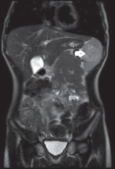 In T2A-weighted coronal sliced sections in magnetic resonance imaging, hyperintense lesion within spleen (white arrow)
