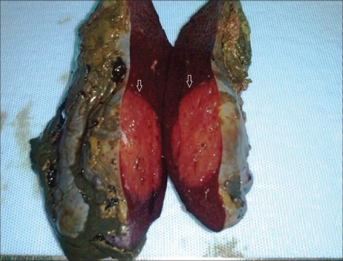 Macroscopically examination revealed on the section surface of the spleen, a red-brown solitary mass (white arrows)