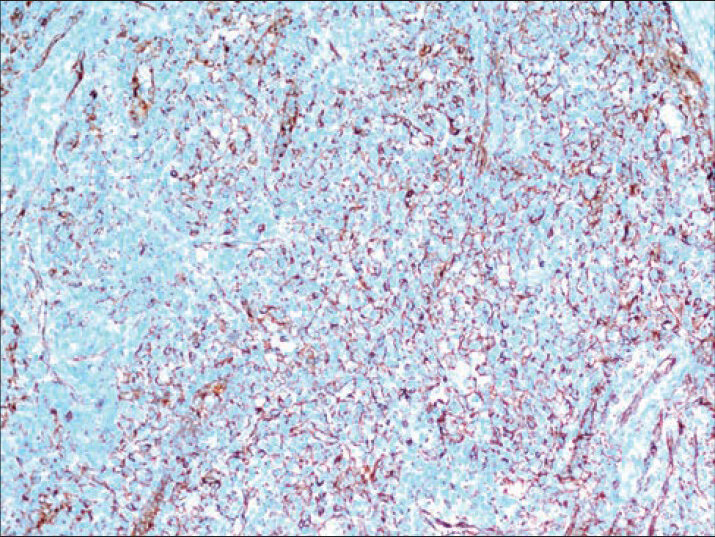 Positive staining of endothelial cells with CD31 (Immunostaining, ×200)