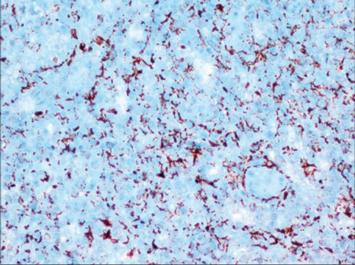 Positive staining of endothelial cells with CD68 (Immunostaining, ×400)