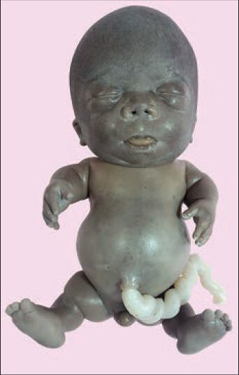 Neonate with a large head, frontal bossing, prominent eyes, hypertelorism, depressed nasal bridge, short neck, narrow chest, protuberant abdomen, micromelia, bowing of legs, abduction of the hip joint