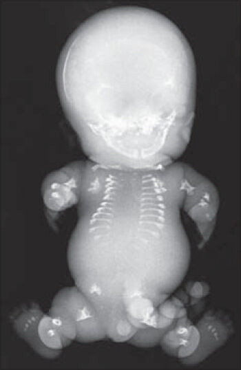 Radiograph showing short ilia, short and curved femora, curved clavicle, short and horizontally placed ribs