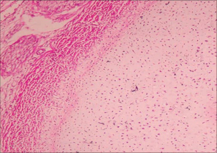 Photomicrograph showing disorganization of physeal growth zone and peripheral band of horizontally oriented fibrosis