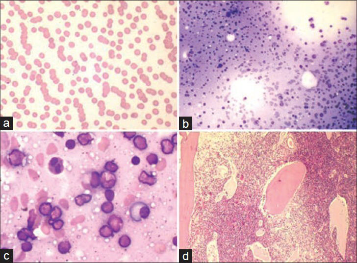Peripheral blood shows rouleaux formation (MGG-Giemsa, ×400) (a). Bone marrow aspirate shows presence of pink homogenous material due to cryoglobulins (MGG-Giemsa, ×200) (b). High power view demonstrates increase in numbers of lymphocytes and plasma cells (MGG-Giemsa, ×1000) (c). Dilated sinusoids filled with pale eosinophillic material are seen on trephine biopsy section (H and E, ×100) (d)