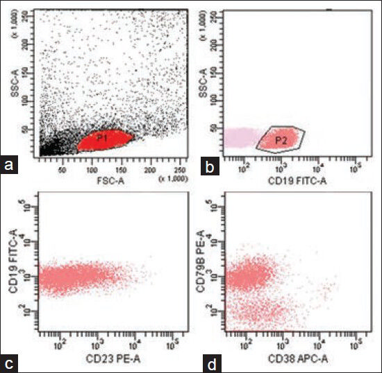 Panel of scatter plots showing the multicolor immunophenotyping of bone marrow aspirate sample by flow cytometry. The gating of cells in each tube has been done on side scatter-A (SSC-A) versus forward scatter-A (FSC-A) (a). The cell is lymphoid region P1 were subsequently gated in SSC-A versus CD19 plot with the gated P2 population showing surface CD19 expression (b). The gated cells show heterogeneous expression of CD23 along with homogeneous expression of CD79b (c and d)