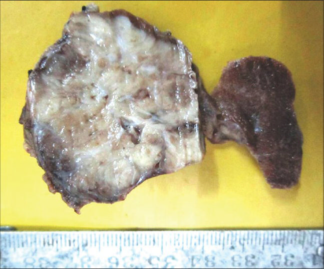 Gross findings of the thyroidectomy specimen: A circumscribed, infiltrative, solid, gray-white mass measuring 4.5 cm × 4 cm × 3.5 cm involving the left lobe and the isthmus. The residual normal thyroid can be seen compressed at the periphery of the tumor. The right lobe was unremarkable