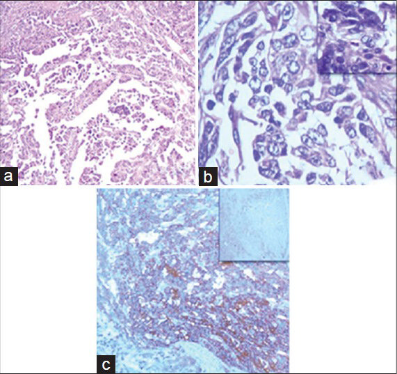 The papillary component of the tumor: (a) The tumor comprised of papillae with fibrovascular core being lined by cuboidal cells with round to oval nuclei (H and E, ×10). (b) The nuclei showed clearing, overlapping, grooving, and the presence of pseudoinclusions (inset) in few cells (H and E, ×40). (c) The tumor showed cytoplasmic immunopositivity for thyroglobulin and immunonegativity for calcitonin (inset) (immunohistochemistry, ×10)