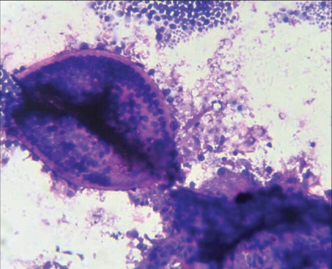 Cytology smear of rhinosporidiosis showing clusters of endospores and intact sporangium (Leishman-Giemsa stain, ×400 view)