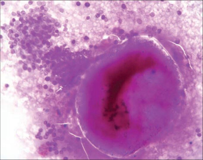 Cytology smear of rhinosporidiosis showing a ruptured sporangium with many endospores and an intact sporangium (periodic acid-Schiff stain, ×400 view)