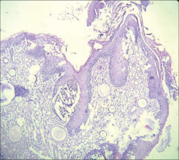 Photomicrograph shows multiple variable sized sporangia in a histopathology section of a case of rhinosporidiosis (H and E, ×100 view)