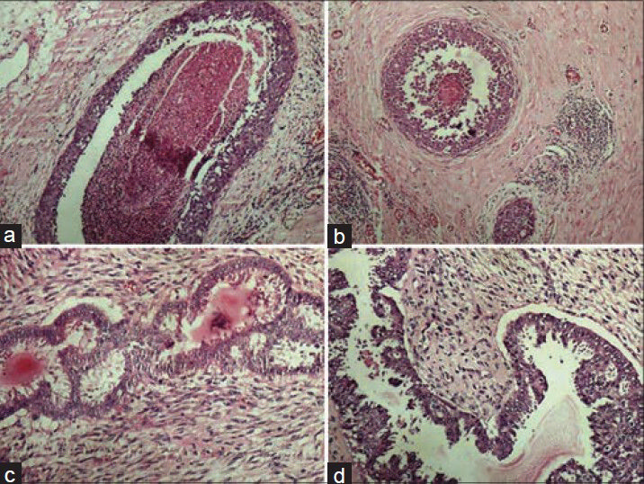 Photomicrographs showing crisp staining in breast tissue (a) DCIS with conventional (H and E, ×100), (b) DCIS with xylene-alcohol free (XAF) (H and E, ×100), (c) Phyllodes tumor with conventional (H and E, ×200), (b) Phyllodes tumor with XAF (H and E, ×200)