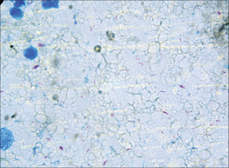 Acid-fast bacilli in aspirates of bacille Calmette–Guerin adenitis (Ziehl–Neelsen, ×400)