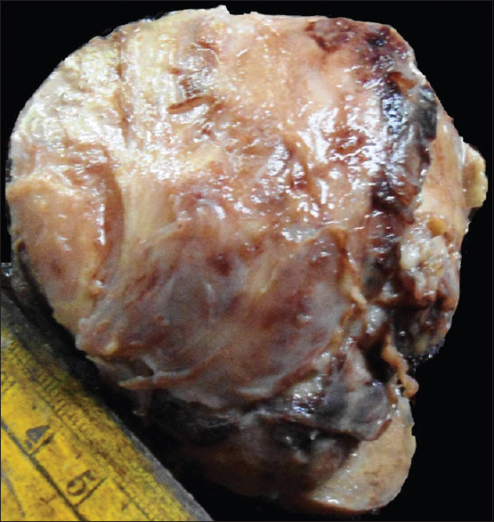 Gross appearance of amyloidoma, showing well circumscribed but un-encapsulated brown colored tumor mass