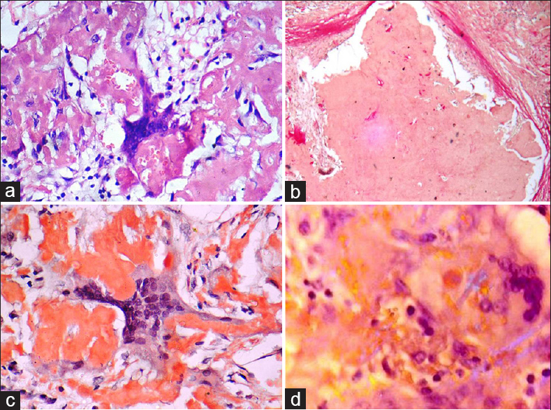 (a) The section showing amorphous eosinophilic deposit of amyloid and exuberant giant cell reaction around the deposit (H and E, ×400). (b) The extracellular amyloid deposit show negative staining with Van Gieson stain (×100). (c) Extra cellular amyloid material staining positively with Congo red (×400). (d) The deposit is showing faint apple-green birefringence on polarization (×400)